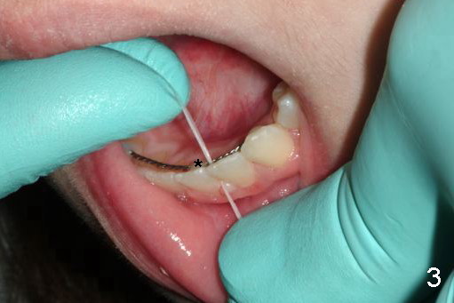 How to fabricate and floss a lingual fixed retainer, Dental Education